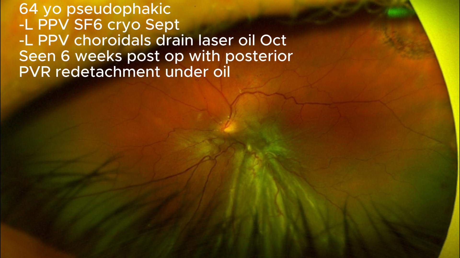 Posterior PVR Redetachment on a Pseudophakic Patient