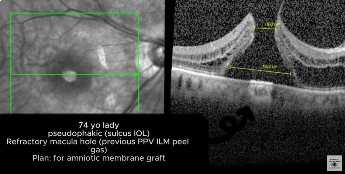 Refractory macula hole treated with amniotic membrane graft