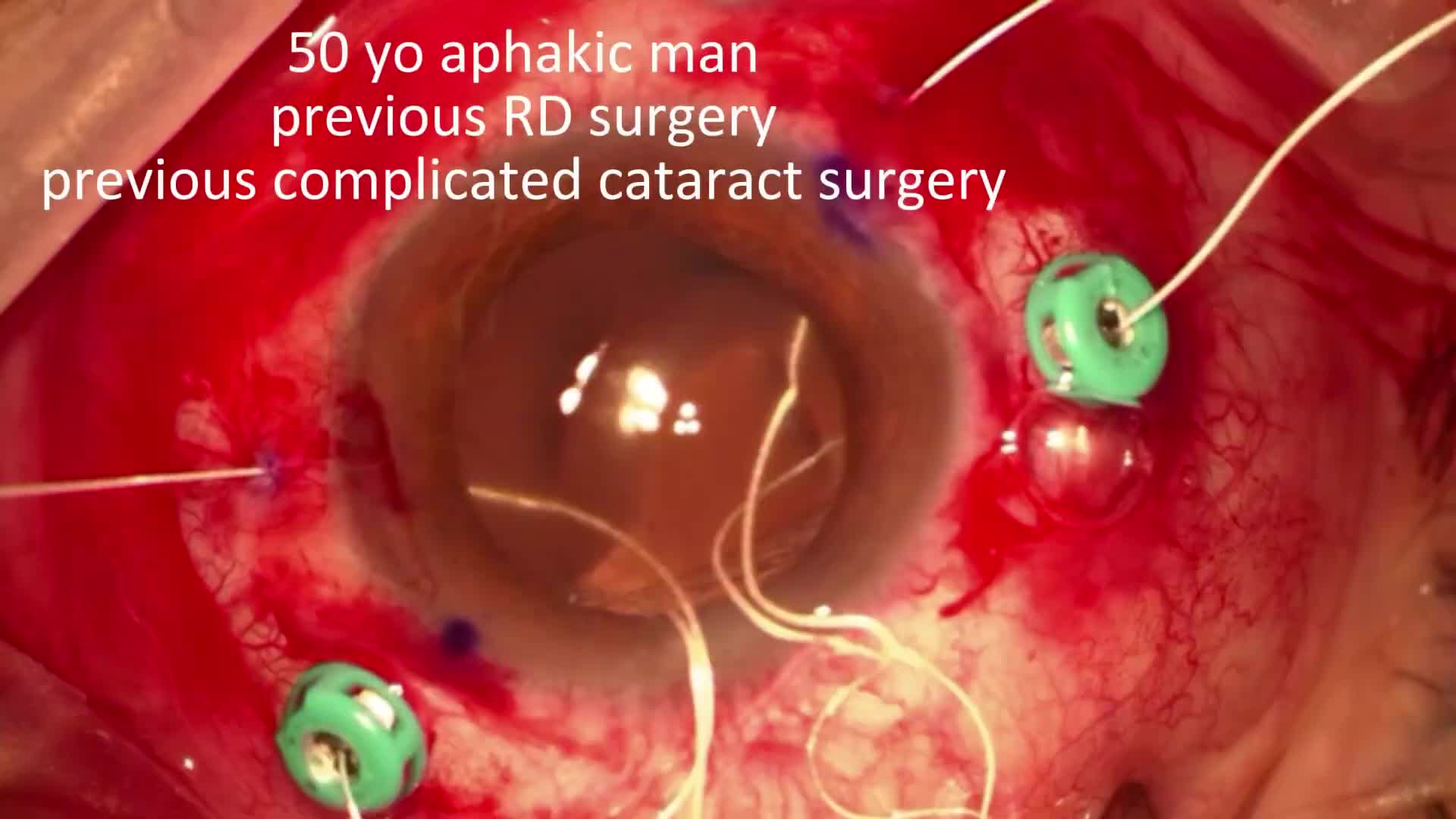 Scleral fixated Akreos IOL with goretex suture for aphakia
