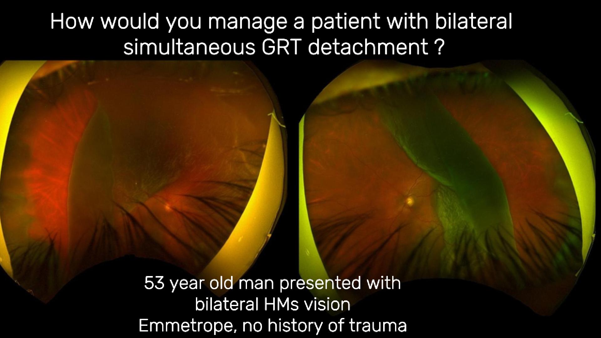 Bilateral simultaneous GRT retinal detachment