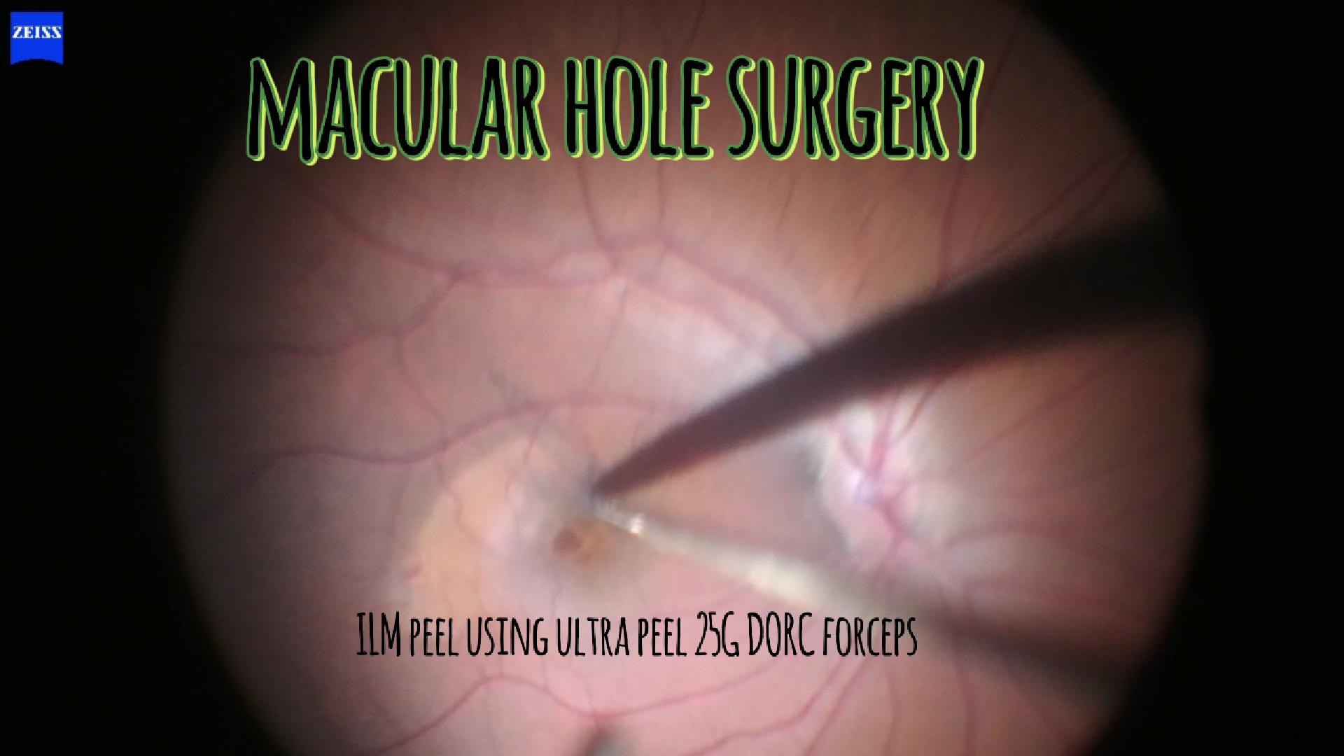 Macular hole surgery